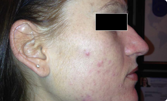 Before-and-after comparison highlighting clearer skin and reduced acne scars after 8 weeks of Celluma LED Therapy.