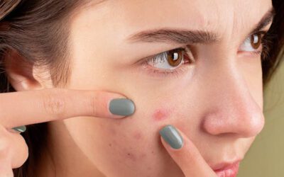 Is Hyaluronic Acid Good for Acne-Prone Skin?