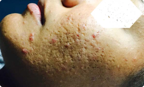 Acne Reduction with Celluma LED Therapy – 2 Weeks Early results showing reduced breakouts and smoother skin after 2 weeks of Celluma LED acne treatments, twice weekly.