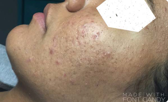 Early results showing reduced breakouts and smoother skin after 2 weeks of Celluma LED acne treatments, twice weekly.