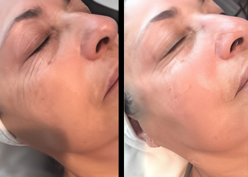 Side-by-side before-and-after images showcasing reduced fine lines and more even skin tone after treatment.