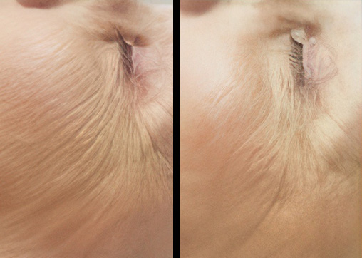 Close-up before-and-after results highlighting refreshed, smoother skin around the eye area.