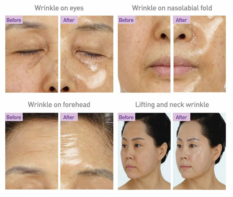 Before-and-after results of the Needle FREE Filler Facial at Facials & Skincare by Debbie in Orange, CA, showing plumper, tighter, and rejuvenated skin.