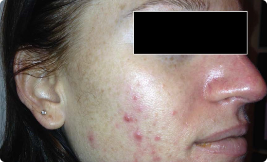 8-Week Before-and-After Celluma LED for Acne Scars Before-and-after comparison highlighting clearer skin and reduced acne scars after 8 weeks of Celluma LED Therapy.