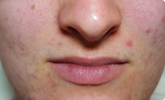 Clearer Complexion After 8 Weeks of Celluma LED Therapy Noticeable improvement in acne and smoother skin tone after 8 weeks of twice-weekly Celluma LED acne treatments.