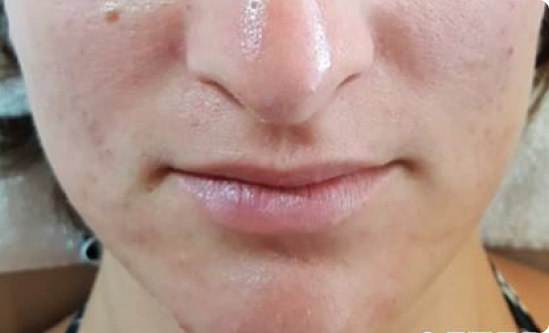 Noticeable improvement in acne and smoother skin tone after 8 weeks of twice-weekly Celluma LED acne treatments.