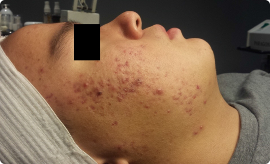 Celluma LED Acne Treatment – 8 Weeks Before and After Before and after results of Celluma LED Therapy showing reduced acne after 8 weeks of twice-weekly treatments.